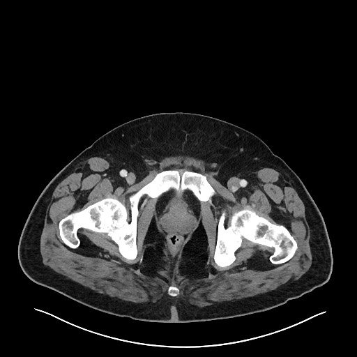 Obstructing sigmoid adenocarcinoma (Radiopaedia 58465-65619 A 160).jpg
