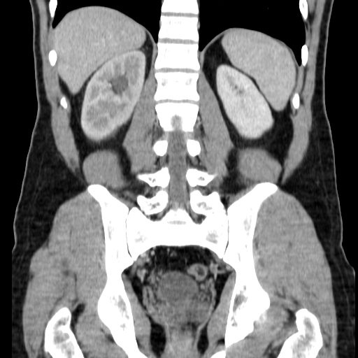 File:Obstructing ureteric calculus (Radiopaedia 18615-18514 C 56).jpg