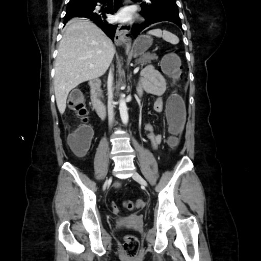Obstructive distal colonic adenocarcinoma causing cecal perforation (Radiopaedia 86830-102989 C 107).jpg