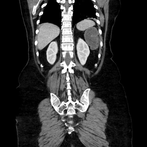 Obstructive distal colonic adenocarcinoma causing cecal perforation (Radiopaedia 86830-102989 C 136).jpg