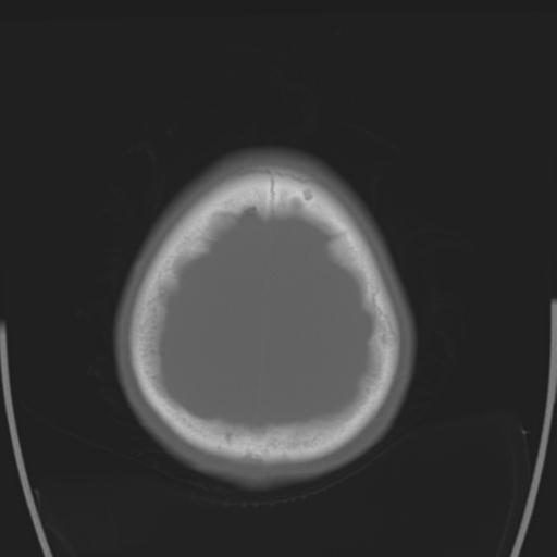 File:Obstructive hydrocephalus (Radiopaedia 30453-31119 Axial bone window 5).jpg