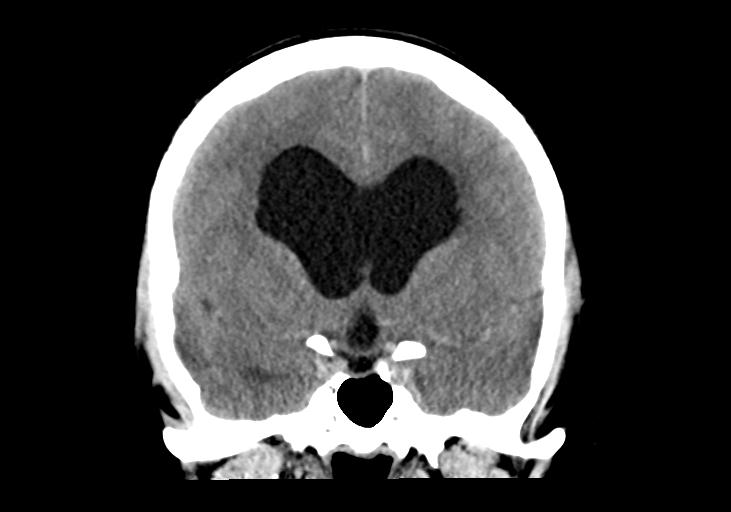 File:Obstructive hydrocephalus (Radiopaedia 30453-31119 Coronal non-contrast 16).jpg
