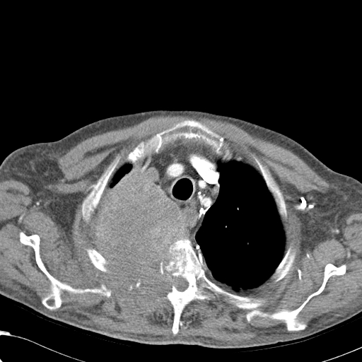 File:Obstructive superior vena cava tumor thrombus (Radiopaedia 28046-28306 A 10).jpg