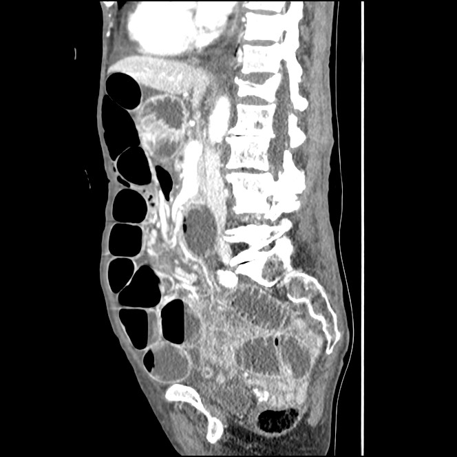 Obturator hernia causing small bowel obstruction (Radiopaedia 65522-74612 C 54).jpg