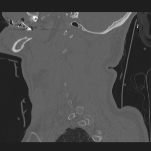File:Occipital condyle fracture (Radiopaedia 33467-34517 Sagittal bone window 15).png
