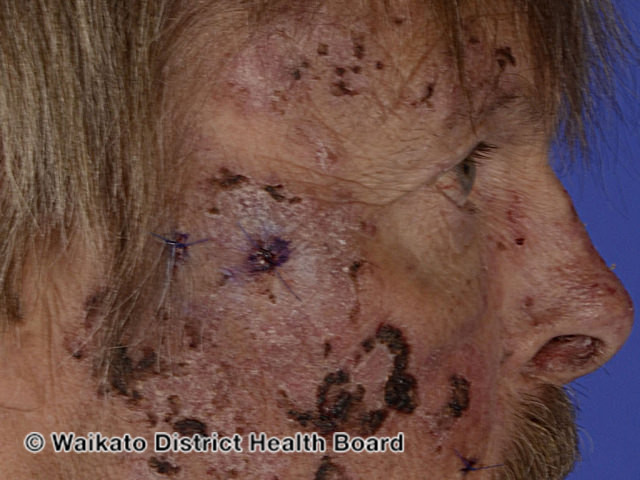 File:Porphyria cutanea tarda (DermNet NZ facial-pct).jpg