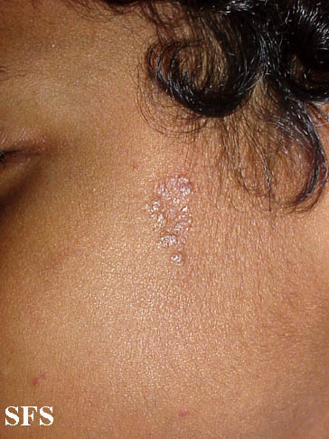 File:Sarcoidosis (Dermatology Atlas 4).jpg