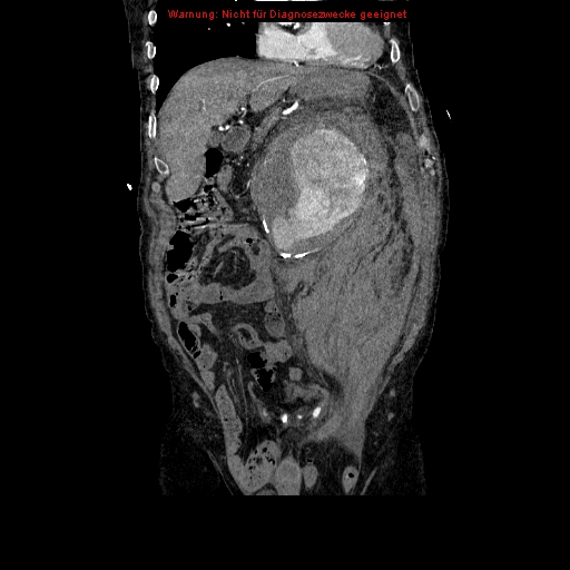 File:Abdominal aortic aneurysm- extremely large, ruptured (Radiopaedia 19882-19921 Coronal C+ arterial phase 36).jpg