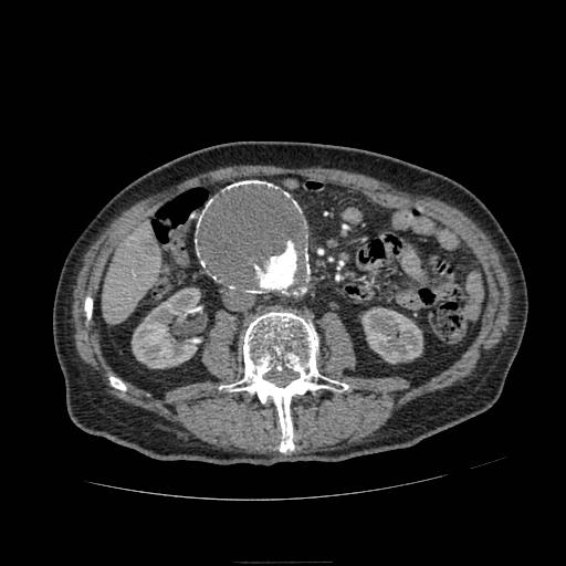 Abdominal aortic aneurysm (Radiopaedia 13341-13340 Axial C+ arterial phase 100).jpg