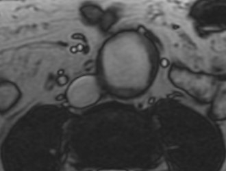 File:Abdominal aortic aneurysm (Radiopaedia 14317-14210 Axial 2D FIESTA (SSFP) 1).jpg