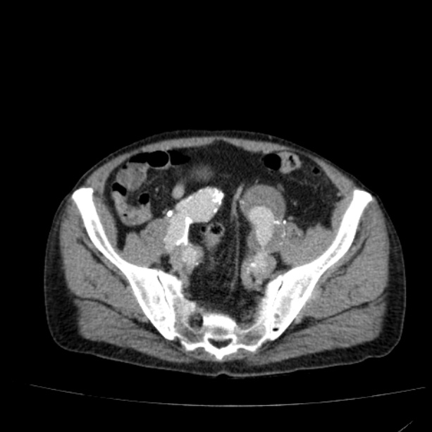 Abdominal aortic aneurysm (Radiopaedia 29248-29660 Axial C+ portal venous phase 48).jpg
