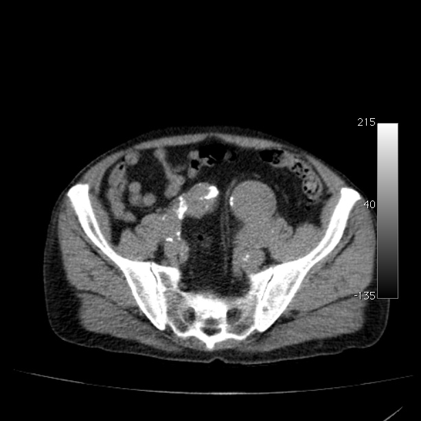 Abdominal aortic aneurysm (Radiopaedia 29248-29660 Axial non-contrast 44).jpg