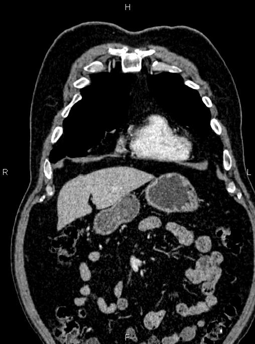 Abdominal aortic aneurysm (Radiopaedia 83094-97462 Coronal renal cortical phase 28).jpg