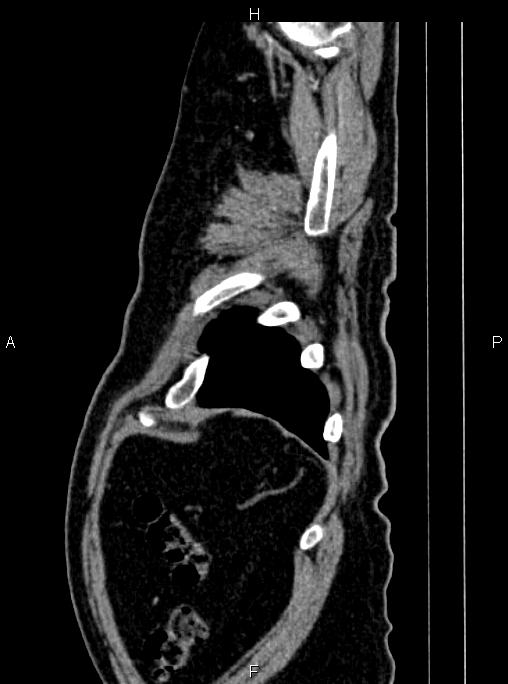 Abdominal aortic aneurysm (Radiopaedia 83094-97462 Sagittal renal cortical phase 115).jpg