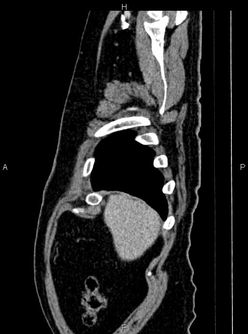 Abdominal aortic aneurysm (Radiopaedia 83094-97462 Sagittal renal cortical phase 16).jpg