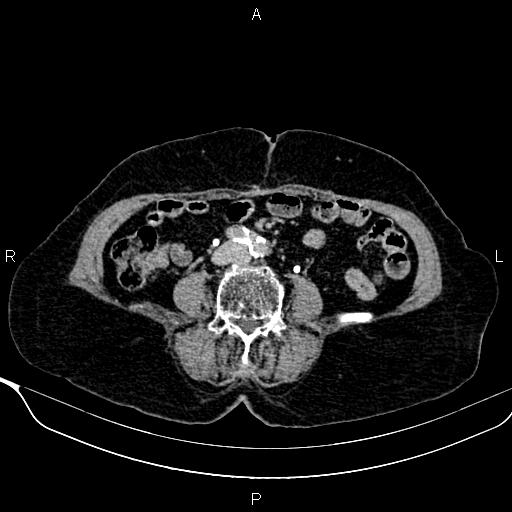Abdominal aortic aneurysm (Radiopaedia 85063-100606 Axial C+ delayed 82).jpg