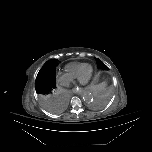 File:Abdominal aortic aneurysm - impending rupture (Radiopaedia 19233-19247 Axial non-contrast 24).jpg