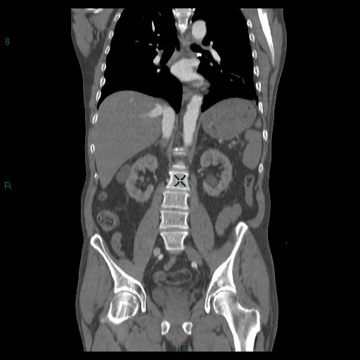 File:Abdominal aortic aneurysm rupture with aortocaval fistula (Radiopaedia 14897-14841 Coronal C+ arterial phase 28).jpg