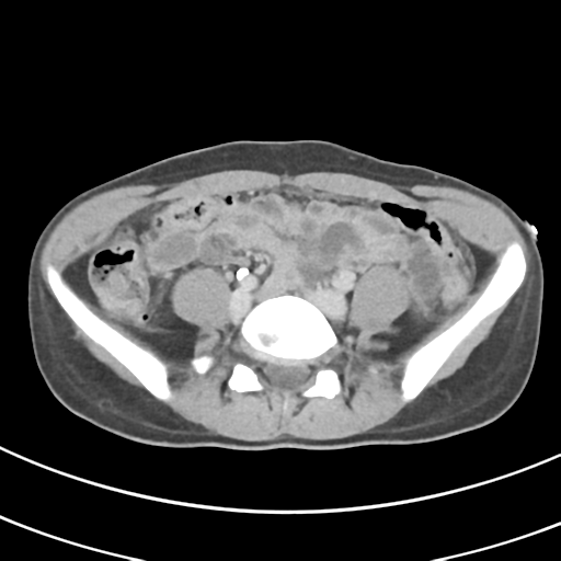 File:Abdominal multi-trauma - devascularised kidney and liver, spleen and pancreatic lacerations (Radiopaedia 34984-36486 Axial C+ delayed 54).png