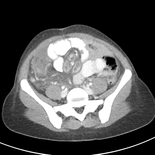 File:Abdominal tuberculosis and appendicitis (Radiopaedia 65631-74735 Axial C+ portal venous phase 49).png