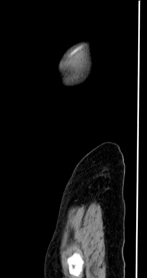 Abdominal wall and retroperitoneal tuberculosis (Radiopaedia 88137-104729 Sagittal C+ portal venous phase 10).jpg