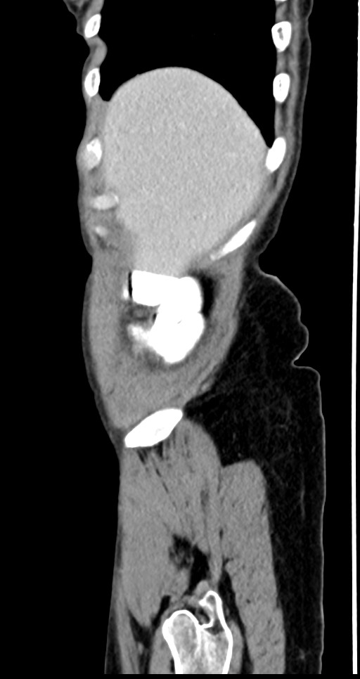 Abdominal wall and retroperitoneal tuberculosis (Radiopaedia 88137-104729 Sagittal C+ portal venous phase 133).jpg