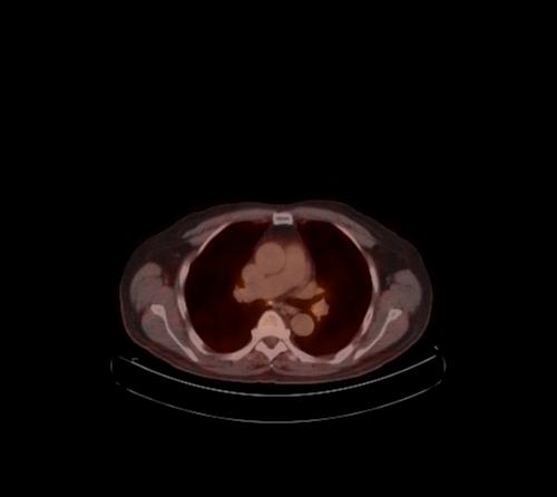 Abdominal wall metastasis from colorectal carcinoma (Radiopaedia 31016-31719 C 110).jpg