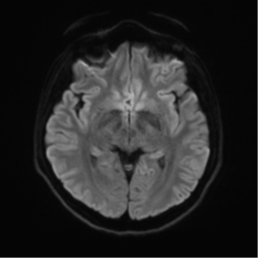 File:Abducens nerve palsy (Radiopaedia 51069-56648 Axial DWI 39).png