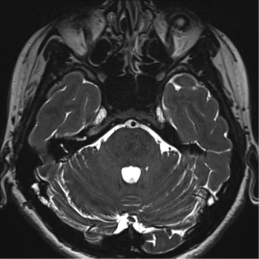 File:Abducens nerve palsy (Radiopaedia 51069-56648 Axial T2 fat sat 33).png