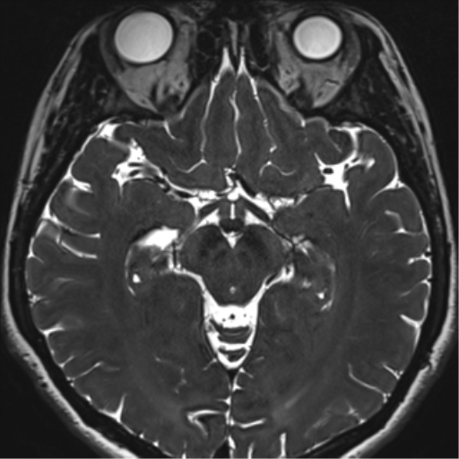 File:Abducens nerve palsy (Radiopaedia 51069-56648 Axial T2 fat sat 73).png