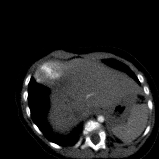 File:Aberrant left pulmonary artery (pulmonary sling) (Radiopaedia 42323-45435 Axial C+ CTPA 39).jpg