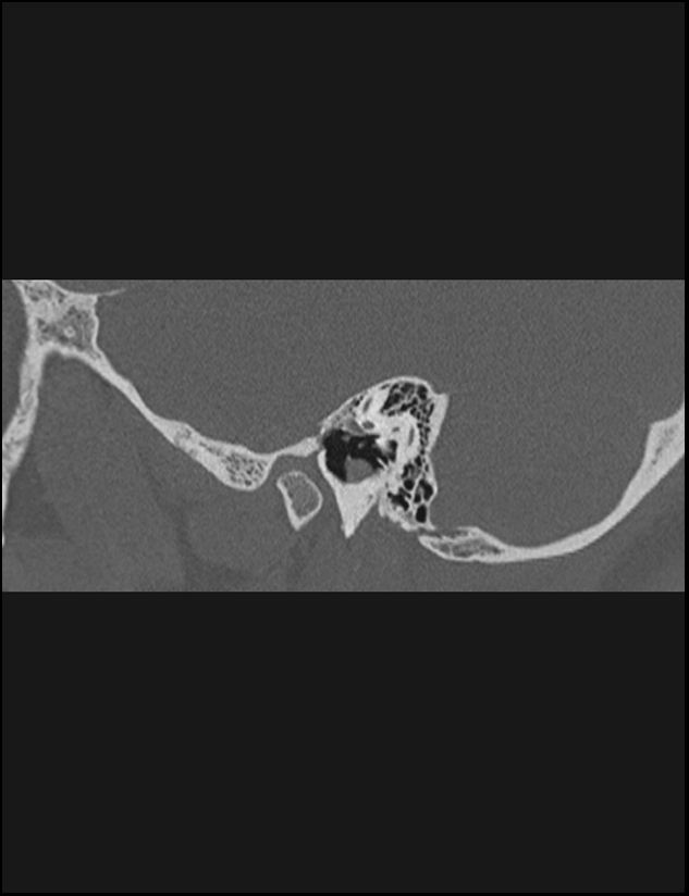 Aberrant right internal carotid artery (Radiopaedia 65191-74198 Sagittal non-contrast 46).jpg