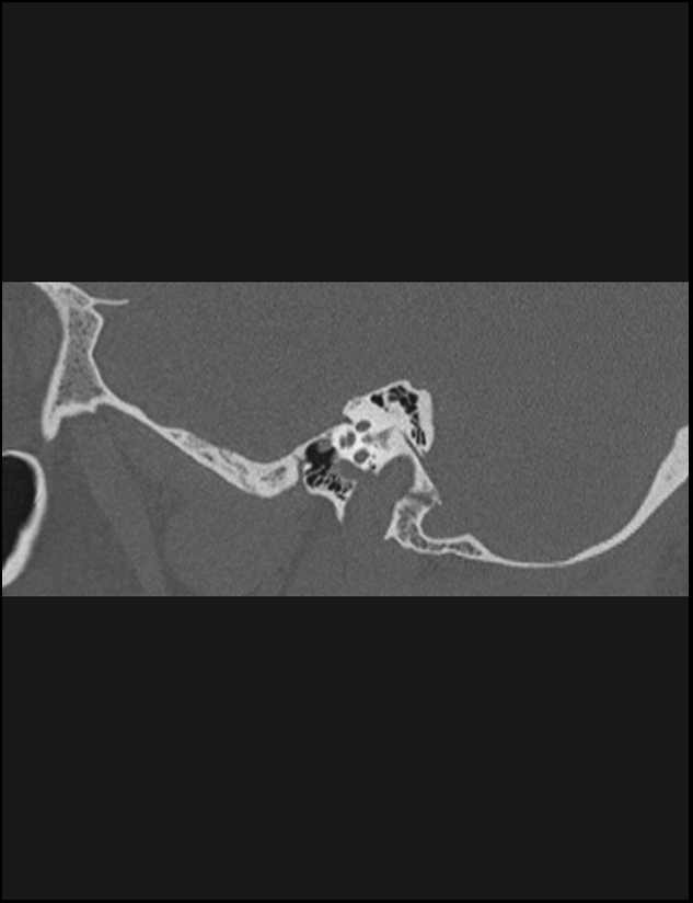 Aberrant right internal carotid artery (Radiopaedia 65191-74198 Sagittal non-contrast 53).jpg