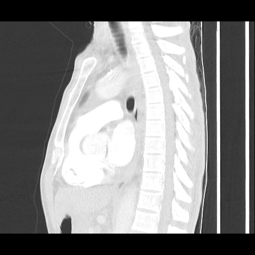Accessory left horizontal fissure with lingular pneumonia (Radiopaedia 53763-59843 Sagittal lung window 37).jpg