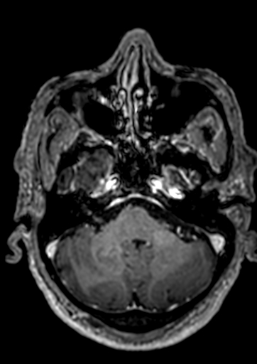 Accessory middle cerebral artery (Radiopaedia 73114-83828 Axial T1 C+ 132).jpg
