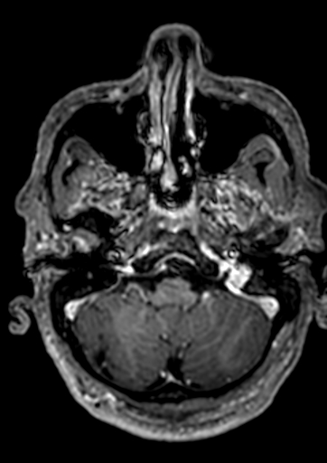 Accessory middle cerebral artery (Radiopaedia 73114-83828 Axial T1 C+ 150).jpg