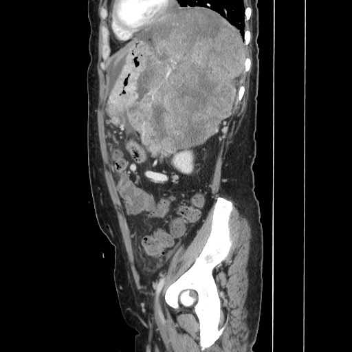 Acinar cell carcinoma of the pancreas (Radiopaedia 75442-86669 Sagittal C+ portal venous phase 136).jpg