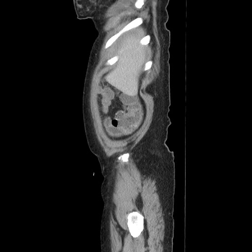 Acinar cell carcinoma of the pancreas (Radiopaedia 75442-86669 Sagittal C+ portal venous phase 32).jpg