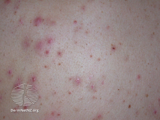 File:Acne affecting the back images (DermNet NZ acne-acne-back-175).jpg