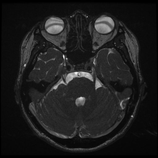 Acoustic neuroma (Radiopaedia 34049-35283 Axial 68).png
