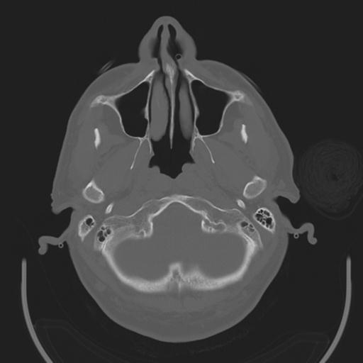 File:Acoustic schwannoma (Radiopaedia 29488-29982 AXIAL BONE THICK non-contrast 5).jpg