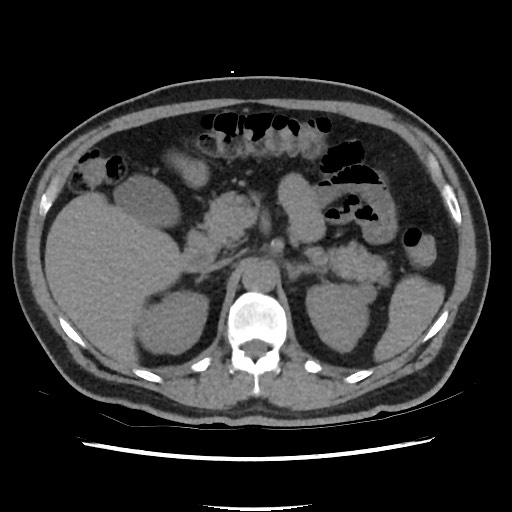 Active colonic bleed on CT (Radiopaedia 49765-55025 Axial non-contrast 24).jpg