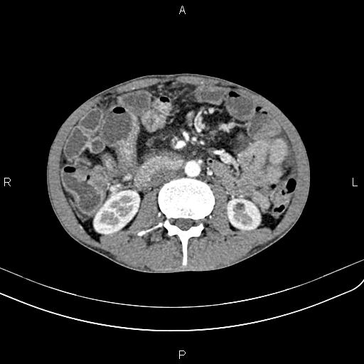Active crohn disease (Radiopaedia 87133-103397 Axial C+ arterial phase 52).jpg
