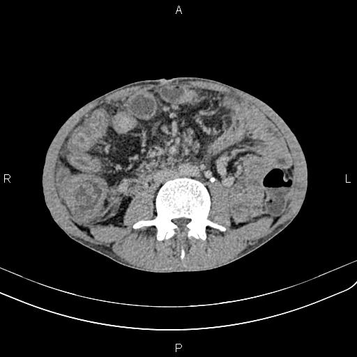 Active crohn disease (Radiopaedia 87133-103397 Axial C+ delayed 33).jpg