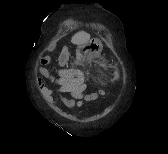 Active renal extravasation with large subcapsular and retroperitoneal hemorrhage (Radiopaedia 60975-68796 Coronal C+ arterial phase 32).jpg