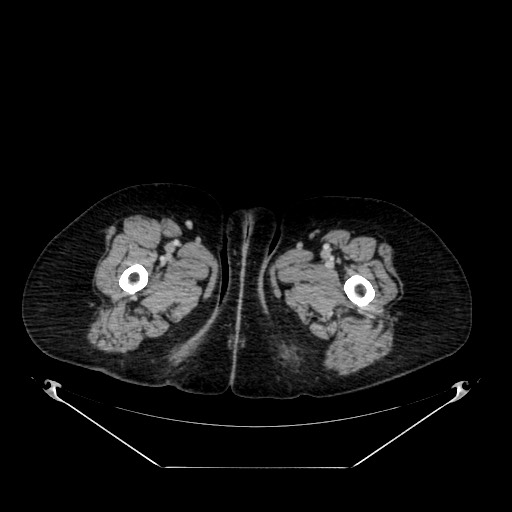 Acute appendicitis, heterotaxy syndrome (Radiopaedia 66884-76202 Axial C+ portal venous phase 150).jpg