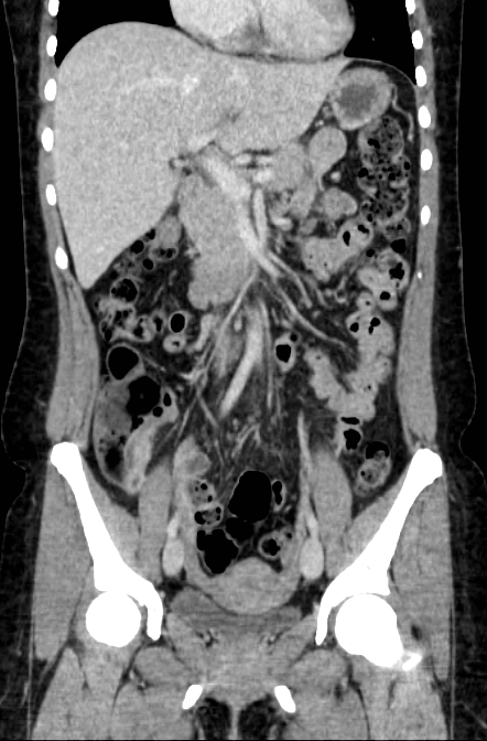 Acute appendicitis (Radiopaedia 22892-22918 Coronal C+ portal venous phase 21).png