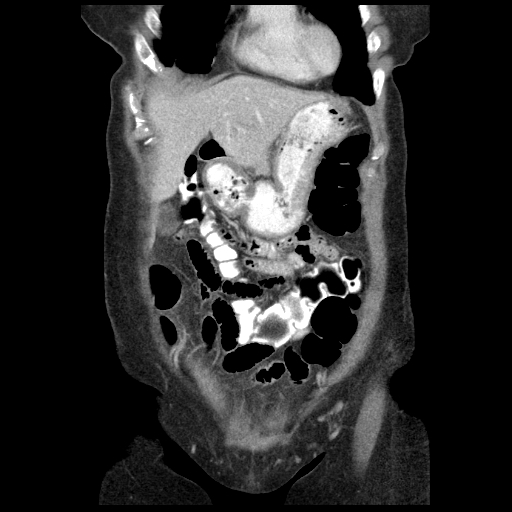 Acute appendicitis (Radiopaedia 52672-58589 Coronal C+ portal venous phase 8).jpg