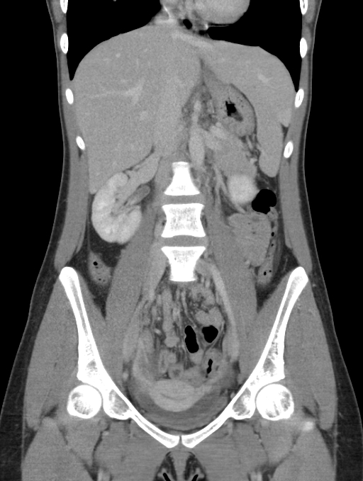 Acute appendicitis (Radiopaedia 62608-70901 Coronal C+ portal venous phase 23).jpg