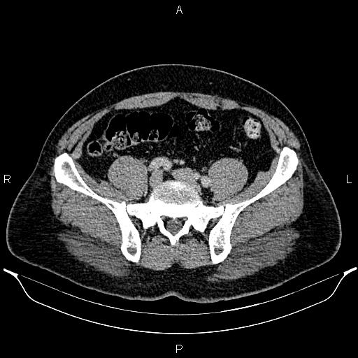 Acute appendicitis (Radiopaedia 84780-100240 Axial C+ portal venous phase 79).jpg